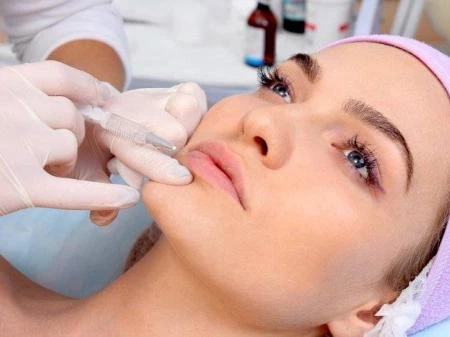 Remplissage Nasolabial