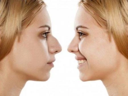 Rhinoplastie