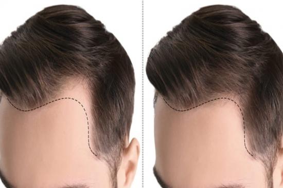 Hairline Lowering in Turkey | TOP 3 Clinics & Prices