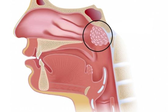 Adenoid removal in Turkey at a reasonable price 2024