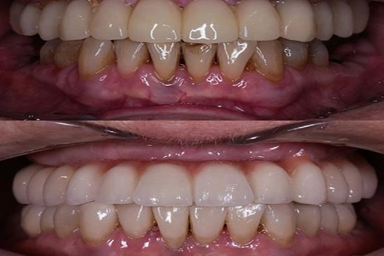 of our patients 0 Dental implants, Istanbul, Turkey, cost, All on four, clinic, orthodontist