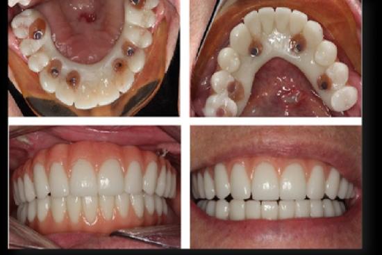 Photos: Before / After 0 in Turkey All-on-6, all on 6,all on 6 dental implants in turkey, implants, Turkey, cost, reviews, dentist, orthodontist,dental clinic, hospital,Istanbul