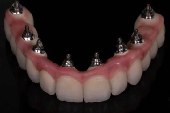 Comment entretenir votre implant dentaire ? 2024