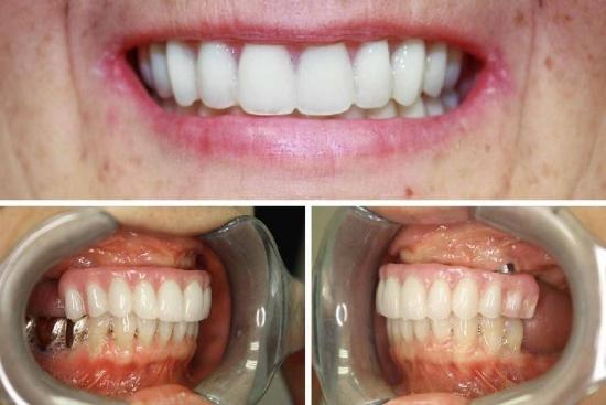  Photos: Before / After 0 in Turkey All-on-8,implants, dental implants, turkey, clinics, cost