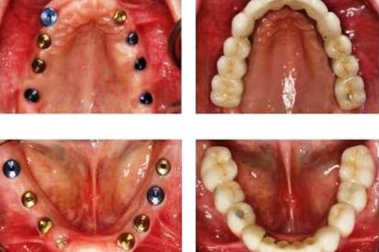 de nuestros pacientes 2 implantes, Turquía, tratamiento All-on-8, precios, beneficios