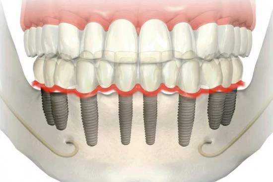 Quels sont les avantages des implants dentaires All on 8? 2024