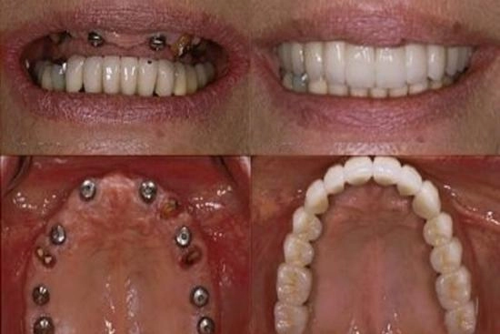 de nuestros pacientes 1 implantes, Turquía, tratamiento All-on-8, precios, beneficios