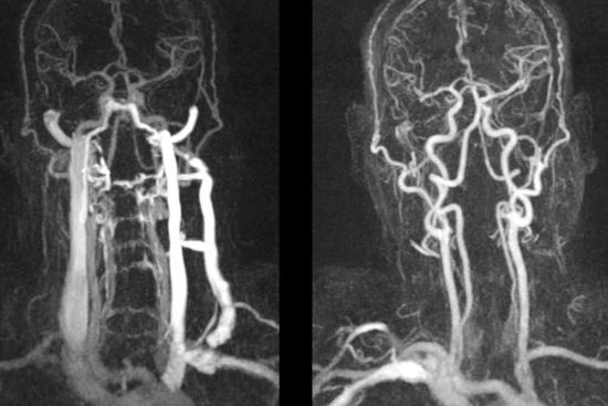 angiographie cérébrale en Turquie