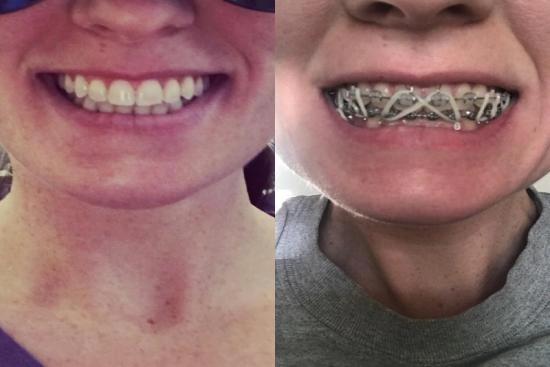 Photos Avant / Après 0 appareil dentaire, Turquie, Istanbul, prix, Gouttière Invisalign, 
