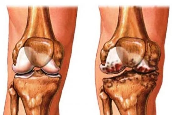 Osteoarthritis treatment Turkey 