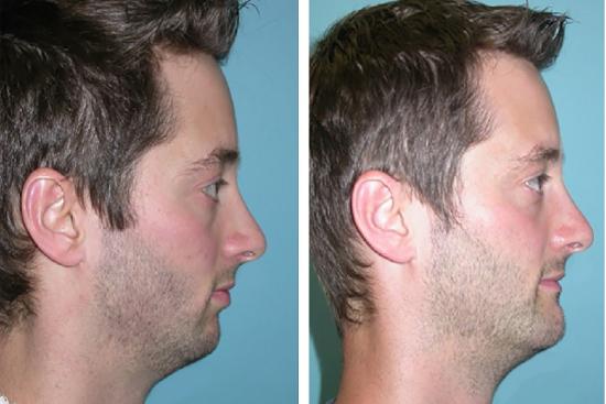 Photos: Before / After 0 in Turkey chin implant surgeons, implant,filler, chin augmentation, filler,liquid chin augmentation,liquid,genioplasty,cost,turkey,istanbul, Antalya