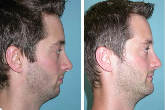 of our patients 0 chin augmentation, turkey, prices, mentoplasty, hyaluronic acid, lipofilling, chin fat transfer