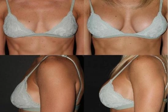 Photos Avant / Après 0 augmentation mammaire, prix, lipofilling mammaire, implants mammaires, Turquie