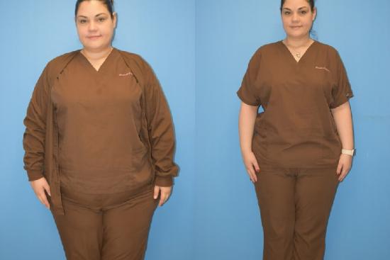  Photos: Before / After 0 in Turkey Orbera, stomach balloon, intragastric balloon, intragastric, stomach, price, turkey,