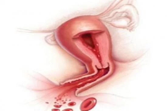 Биопсия эндометрия матки Турция 