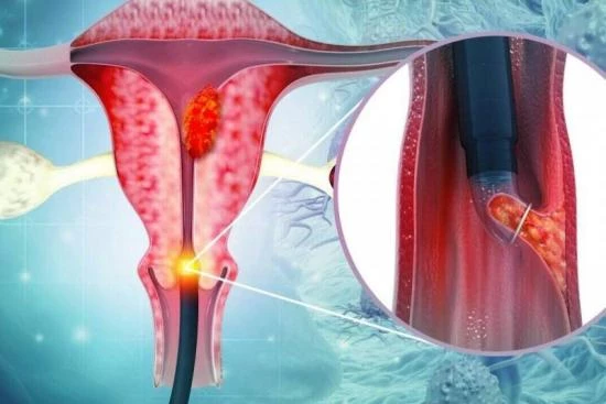 Биопсия эндометрия матки Турция 