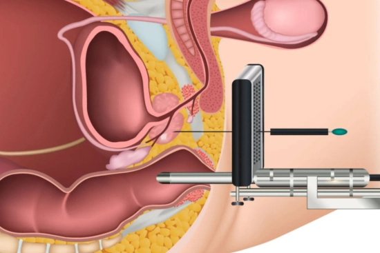 Interpretation of prostate biopsy results 2024