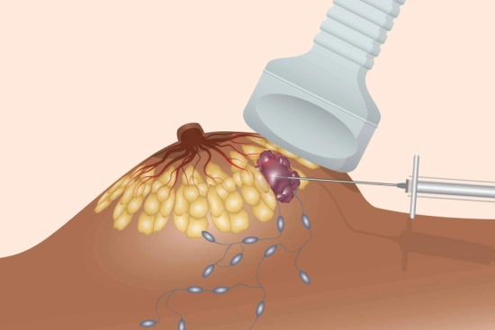 كيف يتم إجراء خزعة الثدي؟ 2026