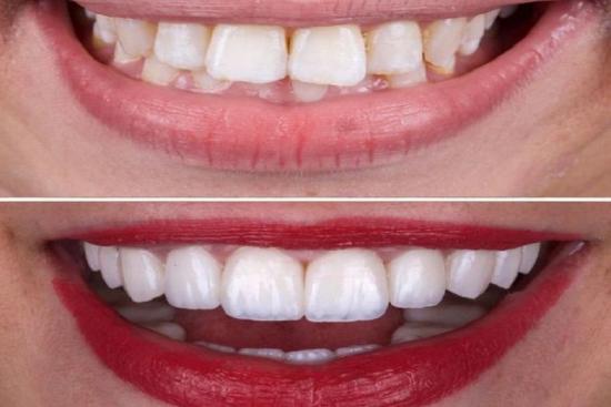  Photos: Before / After 0 in Turkey antalya, zoom whitening, zoom, dentist, teeth whitening dentist, turkey, clinic, price