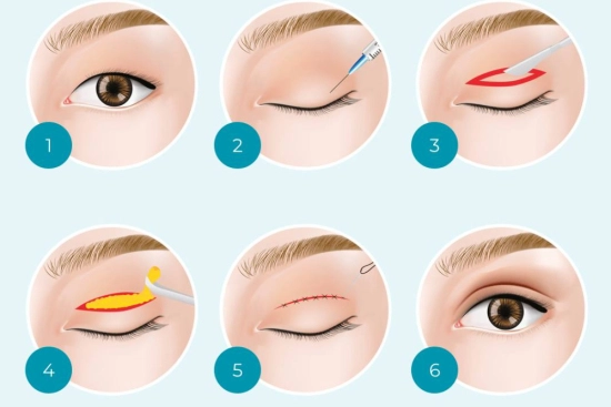Blepharoplasty process (upper and lower) 2026