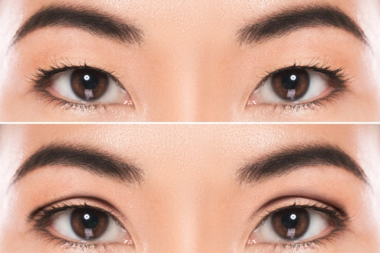 Goals of Asian blepharoplasty (Double eyelid surgery) 2025