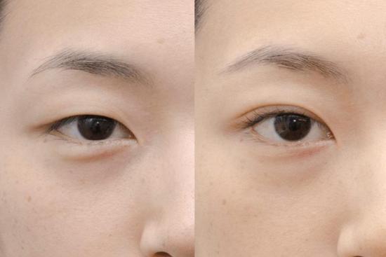  Photos: Before / After 0 in Turkey Asian, eye, surgery, eyelid, palpebral, crease, Istanbul, Turkey, Price