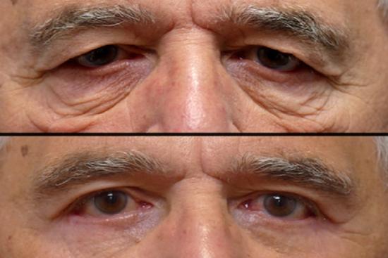 Photos: Before / After 0 in Turkey blepharoplasty, eyelid correction,eyelid surgery,surgery, price, istanbul, turkey, reviews, Antalya
