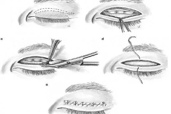 Can eyelid surgery be combined with other cosmetic surgeries? 2024