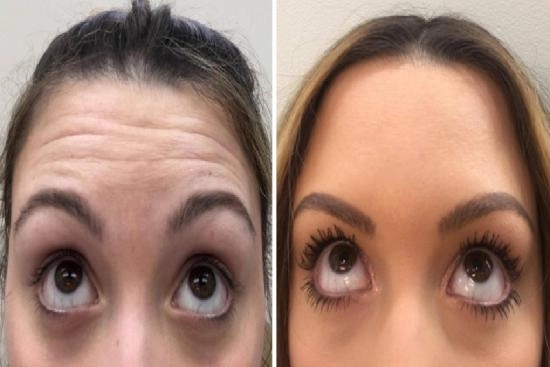 de nuestros pacientes 1 inyección de botox, Turquía, precio