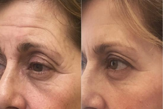 de nuestros pacientes 2 inyección de botox, Turquía, precio