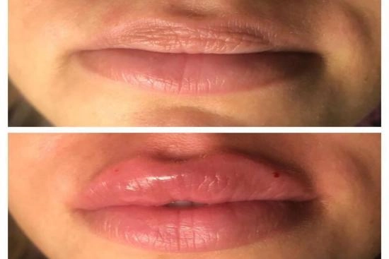 of our patients 0 Botulinum Toxin, lip flip, clinics, doctors, dermatologist, cost, botox, Istanbul, Turkey