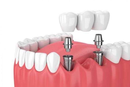 Dental Bridge: Material Choice 2024