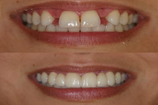  Photos: Before / After 0 in Turkey zirconia crown, tooth bridge, tooth, dental bridge cost, cost, turkey, clinic, dentist