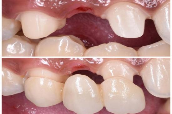 Prothèses dentaires - Clinique Dentaire Dominic Pontbriand