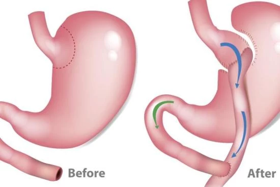 What is gastric bypass? 2024