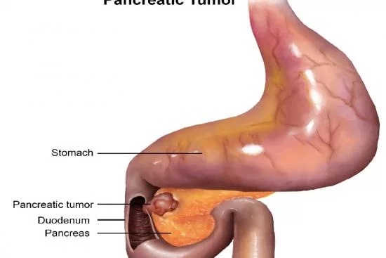 Traitement du cancer du pancréas 