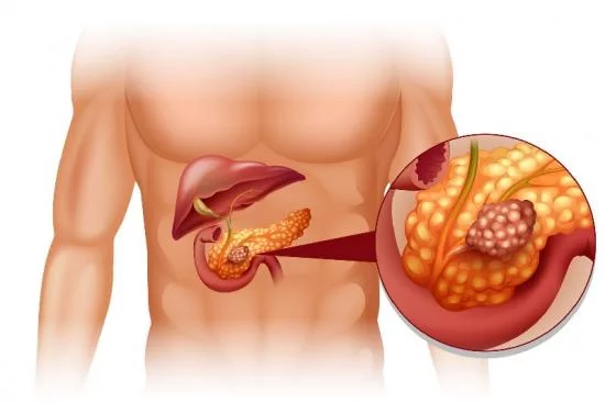 Pancreatic cancer Turkey 