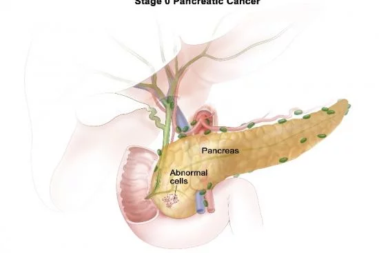 Traitement du cancer du pancréas 
