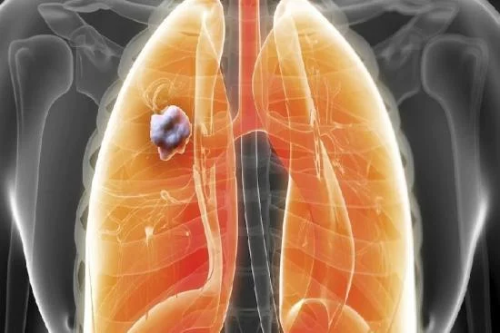 Traitement du Cancer de poumon 