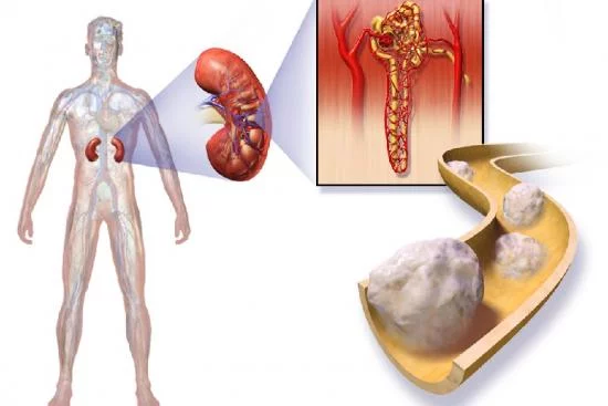 The Best Kidney Cancer Treatment in Hospitals in Turkey 2024
