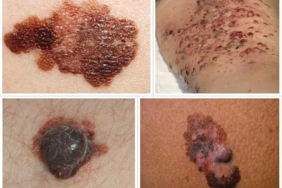 Лечение рака кожи Турция 
