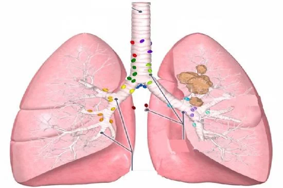 The best lung cancer treatment options 2024