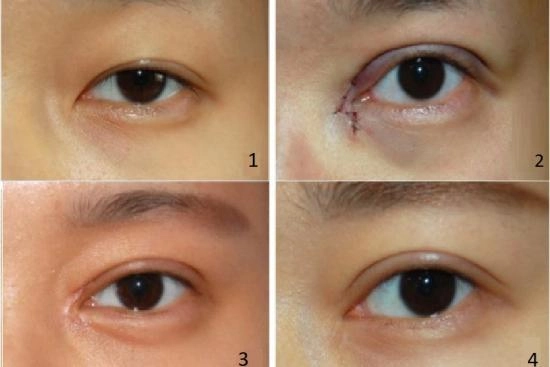 لمرضانا 1 تركيا,إسطنبول,طبيب,الجراح,عيادة,تكلفة,عملية تجميل الجفون,تجميل,نسبة نجاح,مخاطر,بالليزر,العلوي بدون,العلوي بدون جراحة,الجفون العلوية,بالخيوط