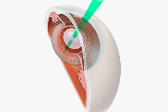 Preparation for YAG laser capsulotomy 2025