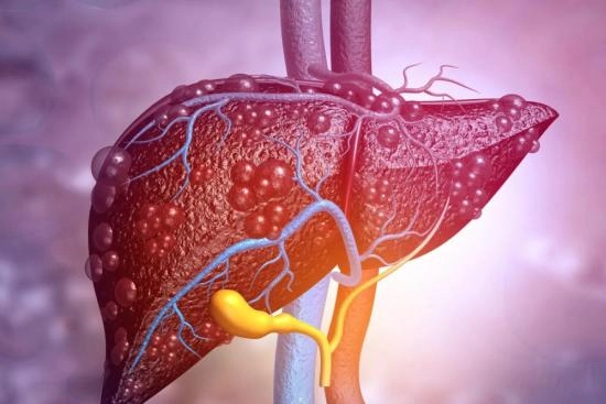 hepatic chemoembolization