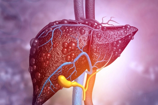 hepatic chemoembolization