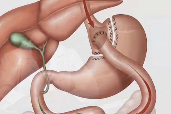 Chirurgie Bariatrique