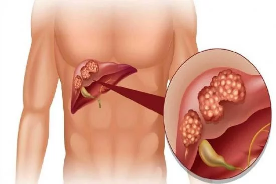 Liver cancer surgery Turkey 