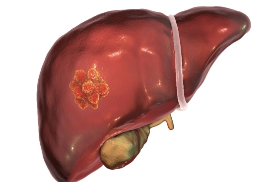 Liver cancer: what is it? 2025