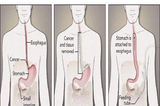 Chirurgie du cancer de l'œsophage en Turquie 2024